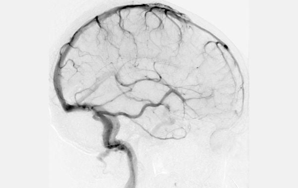 Neuroimaging: Brain Scanning Techniques In Psychology 6 Cerebral angiography