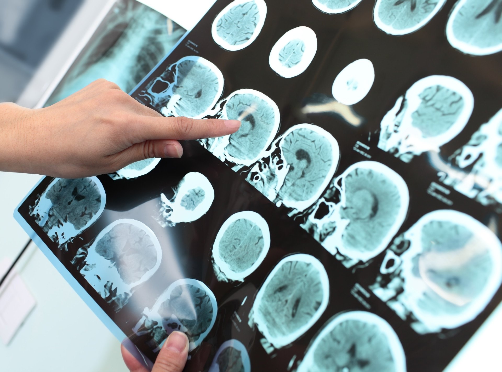 Brain Scans Closer up of a medical professional pointing to a series of brain scans.