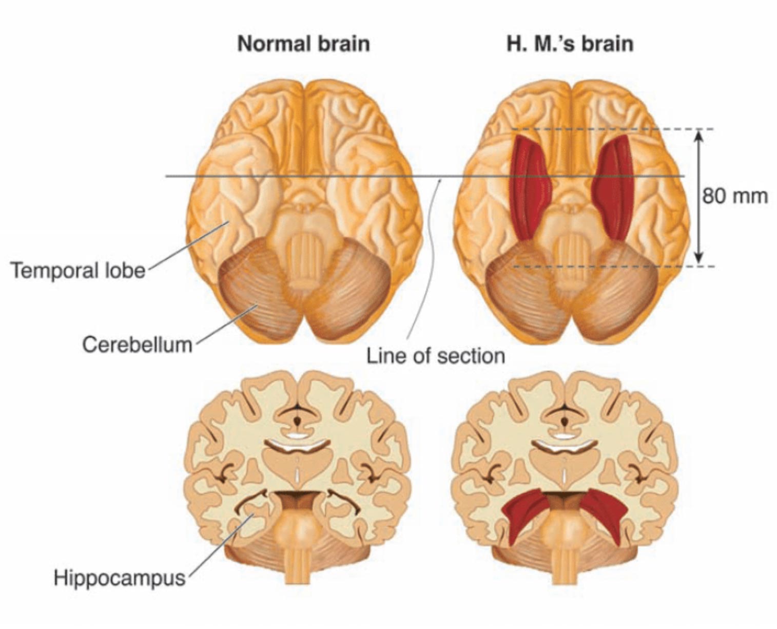 h.m. is a famous case study of someone suffering from